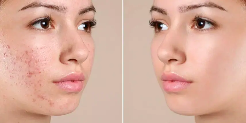 Ảnh: Trị mụn đồng thời với tái tạo da rút ngăn thời gian phục hồi