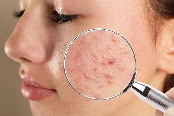 Mụn viêm gây mất thẩm mỹ và khó điều trị triệt để bằng cách thông thường