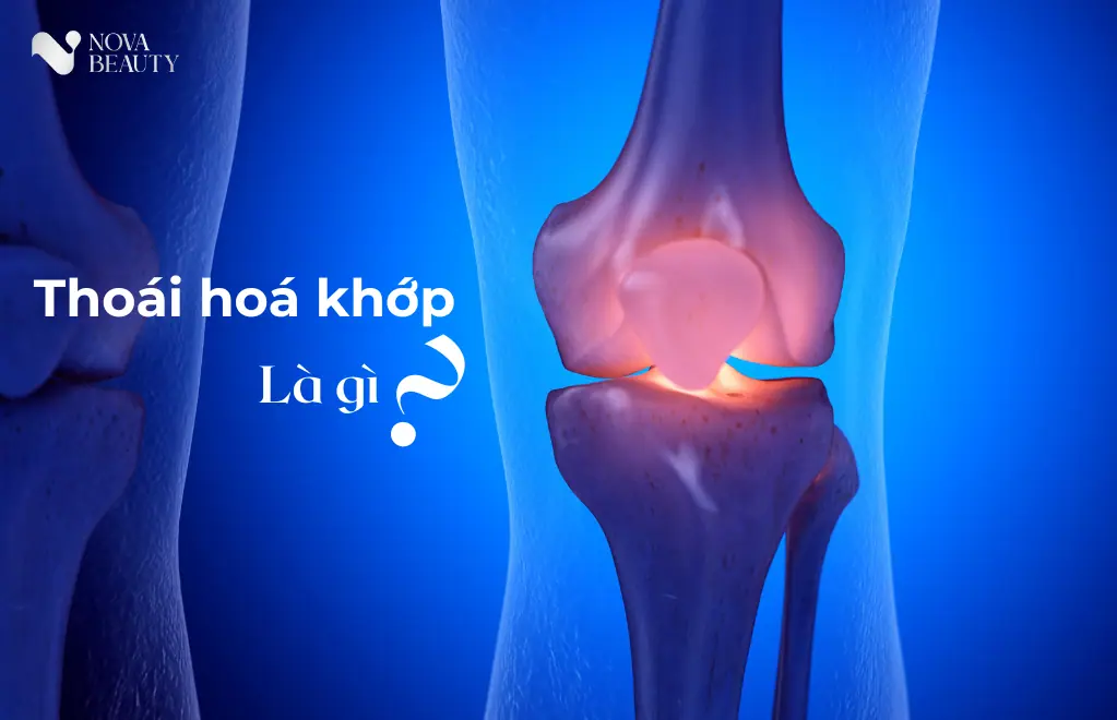 Khái niệm thoái hoá khớp
