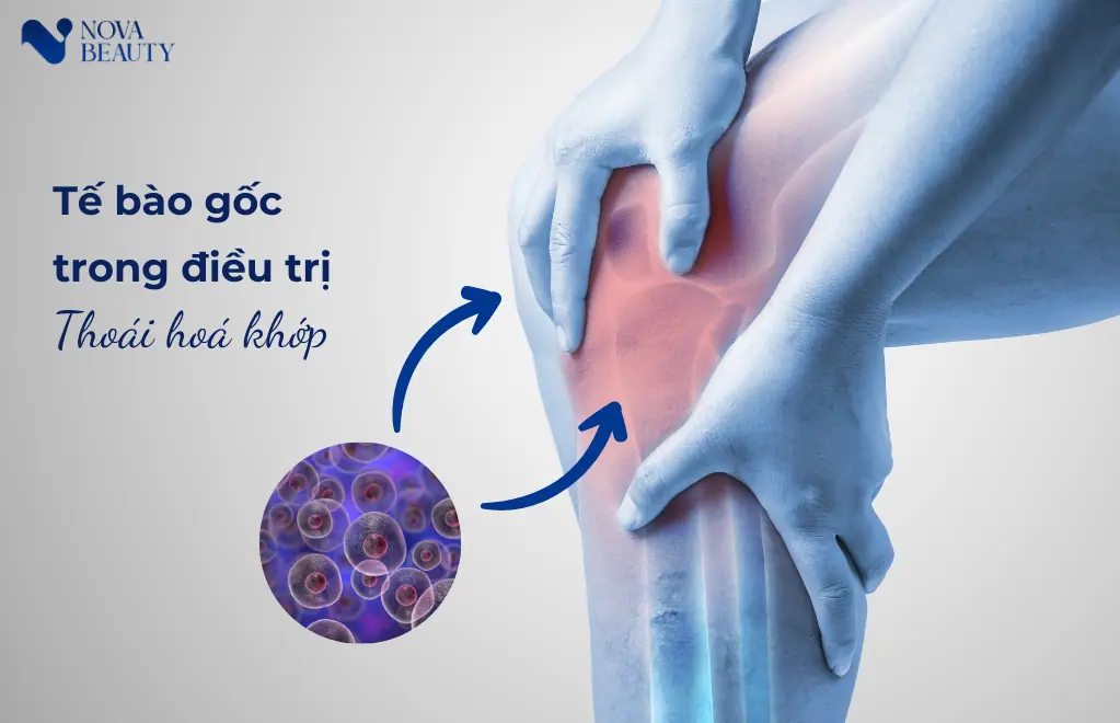 Tế bào gốc trong điều trị thoái hoá khớp